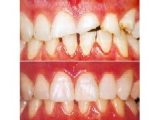 coronas zirconio
